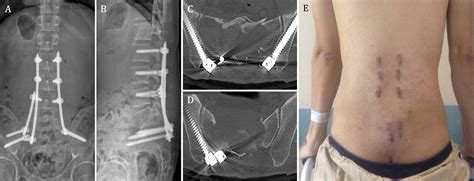 metal brackets pulled from spine|broken spine plate repair.